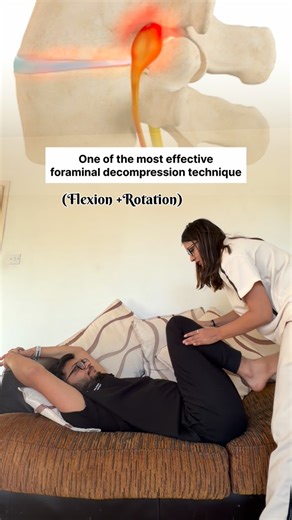 Dr. Drashti Jotaniya on Instagram: "Relieving nerve compression with effective foraminal decompression technique."