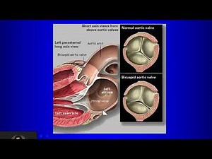 6 Valvular Heart Disease