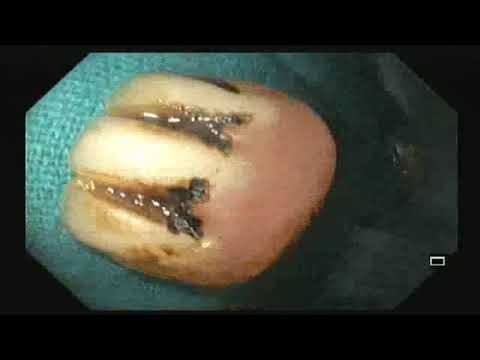 Foreign body (denture) removed from Esophagus