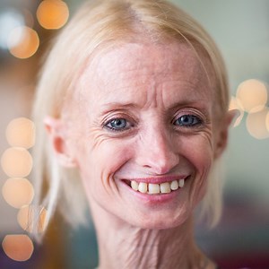 Tiffany ages 8x times faster than normal due to a rare genetic condition called Progeria - but she's determined to lead a healthy and positive life 🙌 | Born Different