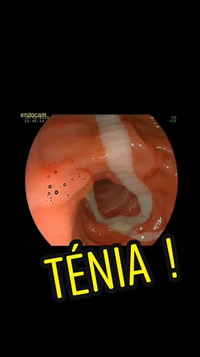 Tout savoir sur le ténia : Un parasite qui inquiète !