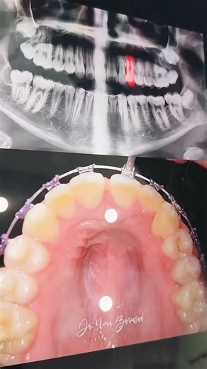 maxillary expansion with canine exposure #reels #teeth #knowledge #study #contentcreator #shorts