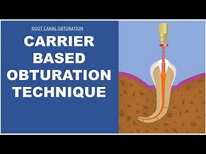 Carrier based Obturation technique