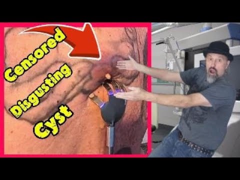 Drainage of a major Infected cyst in my back.