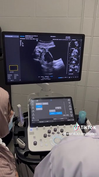 Our First Ultrasound: Expecting Triplets!