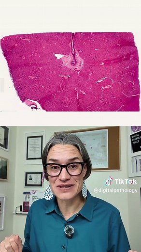 Do you ever get lost trying to orient yourself on a liver histology slide? Here is a simple rule. Blood and bile flow in opposite directions. When I teach liver histology, I always start with two landmarks. The central vein and the portal triad. On H&E you will not see bile canaliculi clearly. But understanding flow helps you orient instantly. Blood flow: • Portal triad → sinusoids → central vein Bile flow: • Hepatocytes → bile ducts in the portal triad This single concept makes liver slides muc