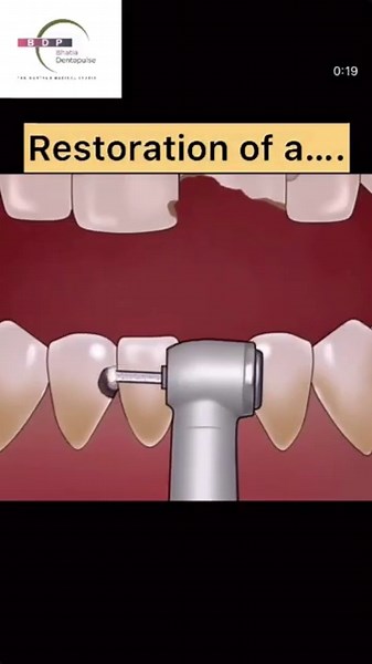 Composite Filling for Fractured Tooth #brokentooth #cavity #dentist