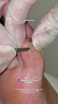 Painful callus on the pinky toe? 👣✨