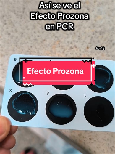 El efecto prozona (o fenómeno de gancho) en la medición de la Proteína C Reactiva (PCR) es un error analítico donde concentraciones extremadamente altas de PCR producen un resultado falsamente negativo o falsamente bajo en pruebas de aglutinación. El inserto de esta prueba recomienda leerla antes de los 3 min ya q es el tiempo máximo de reacción. Sin embargo, por estar muy alta la concentración, la prueba a los 3 min sigue aparentemente negativa. Al realizar las diluciones seriadas, observamos c