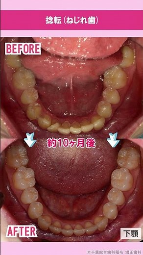 【捻転】コンプリヘンシブパッケージ Before & After #shorts#インビザライト #歯医者 #ビフォーアフター #コンプリヘンシブパッケージ #８８万 #捻転 #shorts