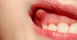 Gum & Tooth Abscess Stages, Symptoms, Treatment & Pictures