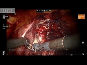 503 Techniques and outcomes of Salvage Robot-assisted Radical prostatectomy- Dr Aditya Parikh