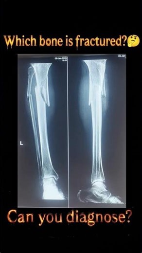 Which bone is fractured can you diagnose?🤔 #shorts #orthodox #medicalquiz #physiotherapy