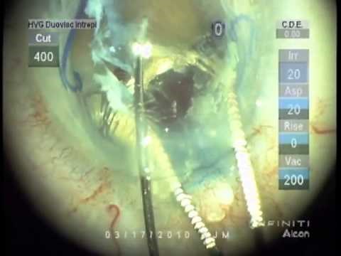 Loose Zonules and Anterior Chamber (AC) IOL