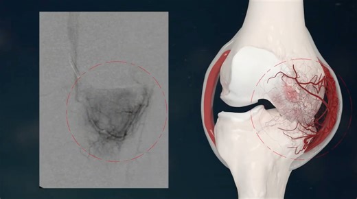 Genicular Artery Embolization (GAE)
