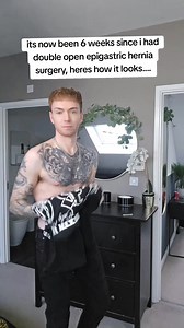 It's been 6 weeks since double open epigastric hernia surgery and I'm pretty much 100% but still got to take it easy | james hinchliffe - tattooedgingerlad