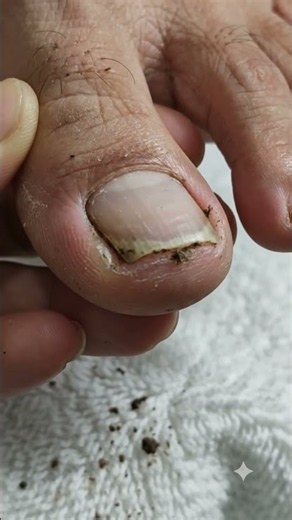 Extreme Toenail Restoration! Removing Dirt & Cleaning Damaged Nail 😱
