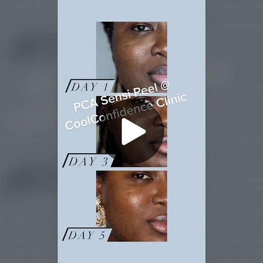 Check out @GlamazonDiaries Before & After one round post PCA sensi peel at CoolConfidence Clinic! Even skin tone, texture, pigmentation, and get rid of breakouts! Ask about our magic! ☎️ 347-727-2665 ##glamazon##glamazons##hyperpigmentationtreatment##hyperpigmentation##darkskin##darkskingirl##pigmentation##peel##chemicalpeeljourney##chemicalpeel##acne##acnetreatment##beforeandafterskincare##nycskincare##darkspottreatment##darkspotserum##serum