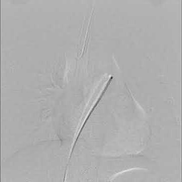 PULMONARY ANGIOGRAPHY