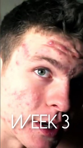 Get rid of your acne with my program TheAcneMethod.com! What happened on world's highest dose? #acne