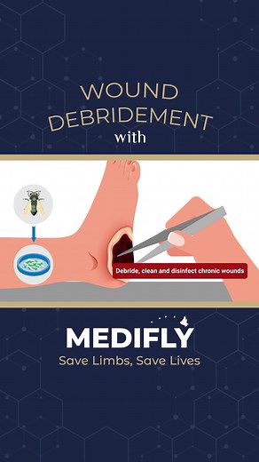 Maggot Debridement Therapy (MDT) for Diabetic Foot | Atlas Podiatry Singapore