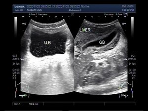 Ultrasound Video showing Gallbladder wall thickening in a patient with Acute viral hepatitis (AVH).