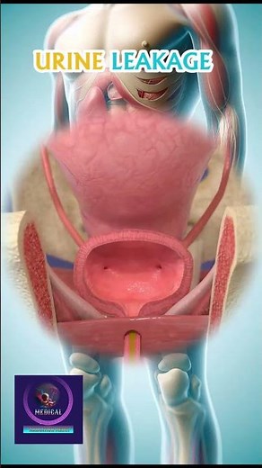 Urine Leakage & Overactive Bladder Disease