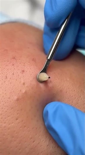 MASSIVE Blackhead Extraction So Satisfying