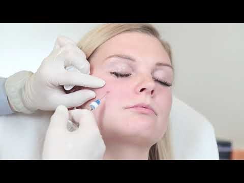 Cheeks with Restylane LYFT