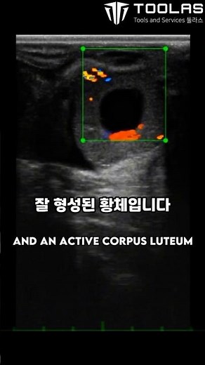 실제 사례로 보는 초음파진단기 컬러 도플러 활용법