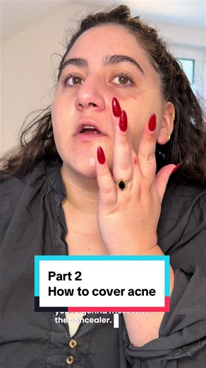 How to Cover Acne After Popping Pimples — Part 2