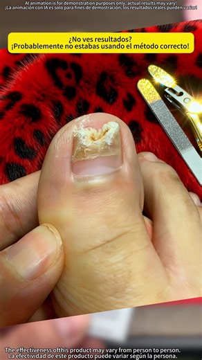 Yes!!!!Work!!💅💅👍👍✨✨💗💗#nailcare #nail #yellownails #toenail #nailtok #healthynails #fungustreatment #tonenail