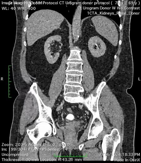 Ct Urogram Excretory coronal