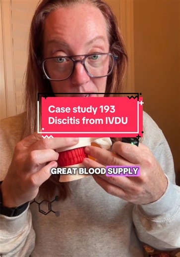 Replying to @Kristen :) Case Study 193: Discitis Discitis is a rare but serious infection of the intervertebral disc space. It often develops when bacteria (like Staph aureus or MRSA) spread through the bloodstream - sometimes from IV drug use, skin infections, or even dental procedures. Once bacteria lodge in the disc, inflammation sets in, destroying the disc and sometimes spreading to nearby bone (osteomyelitis) or even the spinal canal (epidural abscess). 🔎 Key facts to know: \t•\tSymptoms:
