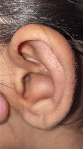 🦻 Painful Ear Infection in an Adult #EarInfection #EarPain #entertainment