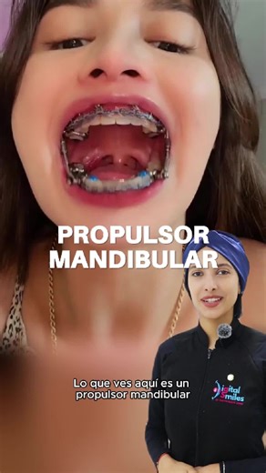 Propulsor mandibular: Mejora tu sonrisa con brackets