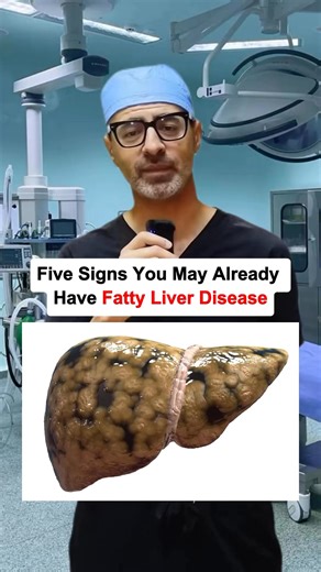 123K views · 1.1K reactions | Five Signs You May Already Have Fatty Liver Disease. #fattyliver #fattyliverdisease #healthtipsdaily #healthtips | Doc Tips | Facebook