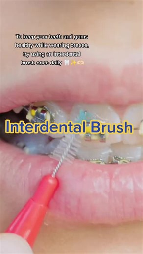 Effective Oral Hygiene with Braces: Interdental Brushing Habits
