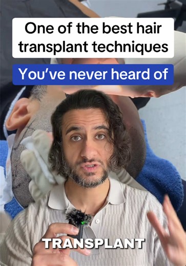 Stick and place is a hair transplant implantation technique where the surgeon creates a tiny incision in the scalp and immediately inserts the graft into that same opening one by one. Instead of making all the recipient sites first and placing the grafts afterward, both steps are done simultaneously. This allows the surgeon to control the angle, direction, and depth of each graft in real time. When performed by an experienced surgeon, potential benefits can include more precise hairline design, 