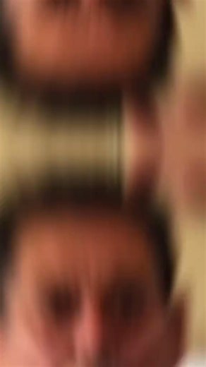 This is creudtzfeldt jakob disease which is the human variant of mad cow disease. #disease #sick #prions #medical #educational #medtok #doctor | Intelligent Doctor