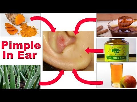 Pimple In Ear, No Problem, Just Follow These 5 Magical Tips.