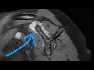 Solving a Shoulder MRI