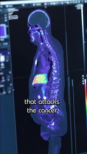 Pluvicto and the Rise of Theranostics in Cancer Care