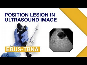 EBUS-TBNA | Positioning the Lesion in Ultrasound Images | Respiratory