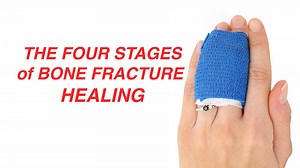 VIDEO: The Four Stages of Bone Fracture Healing