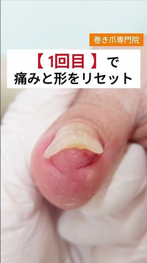 Actually, the cause of ingrown toenails is bunions. When you have a bunion, your big toe becomes ...