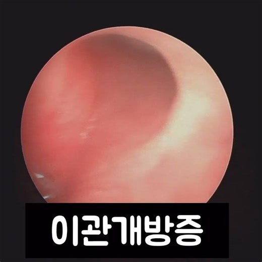 내 말소리가 울릴 때 이관 입구 내시경을 본다면? #이관개방증 #귀에서숨소리 #귀먹먹함