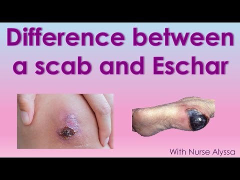 What is the difference between a Scab and Eschar