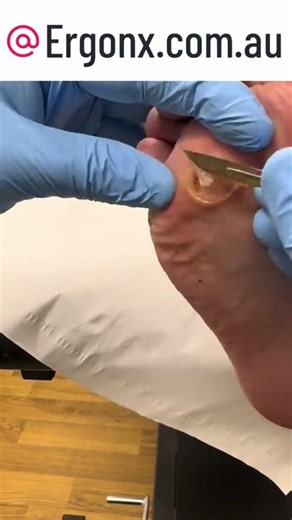 Satisfying Callus Removal! Watch a Podiatrist Transform Painful Feet #CallusRemoval #Podiatry