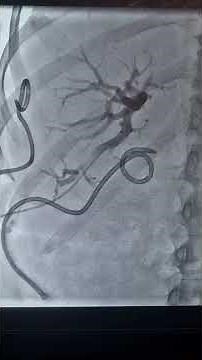 Percutaneous internal/external biliary drainage (PTBD) for malignant hilar biliary obstruction